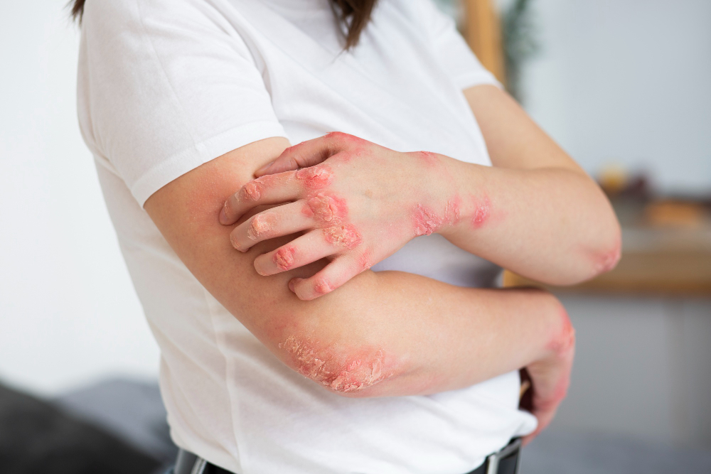 Cos'è la psoriasi?